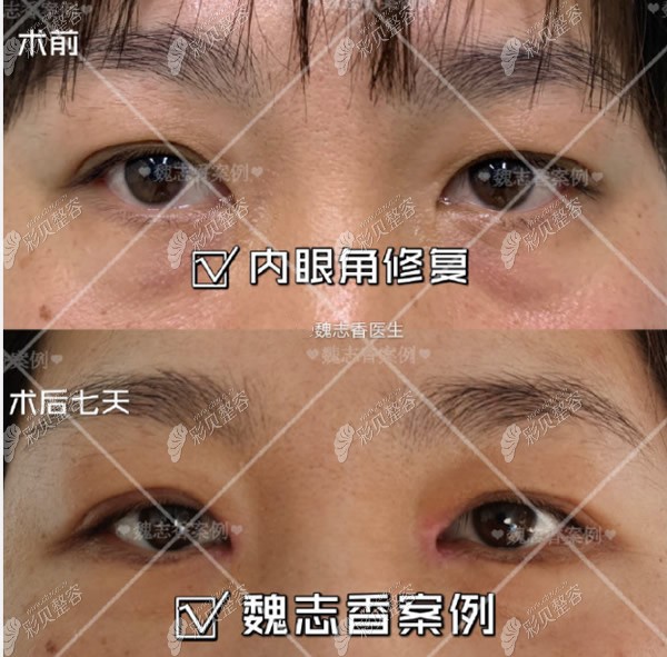 听说北京魏志香双眼皮修复案例很多,她修复内眼角眼袋