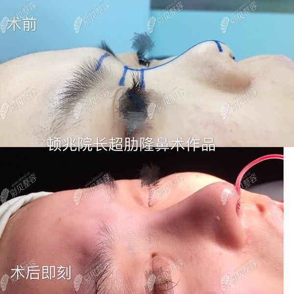 南京艺星顿兆医生做鼻子手术案例和图片:看挛缩鼻怎么