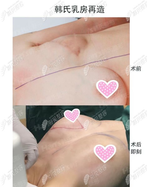济南韩氏亓发芝做乳房再造手术,价格可享公益援助