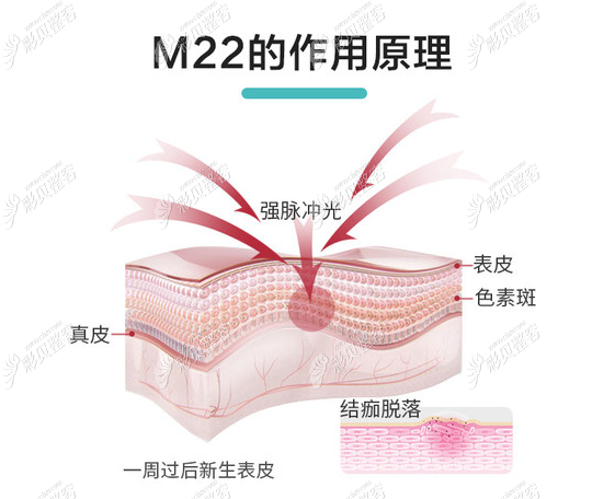 长春中研美容医院m22光子嫩肤去面部红血丝效果