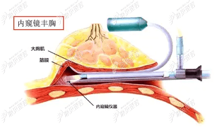 北京画美赵作钧医生隆胸不错他做的动感假体丰胸手感真实