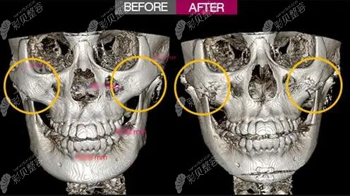 颧骨术前术后ct片对比图片