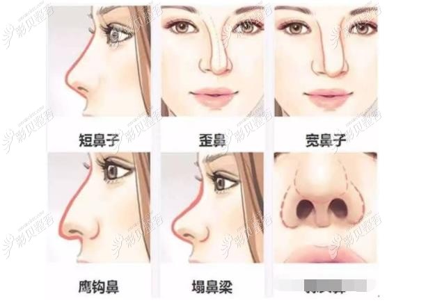 短鼻子,歪鼻,宽鼻,鹰钩鼻都可以做鼻综合改善