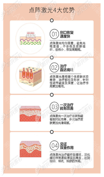 广西南宁爱思特点阵激光优势