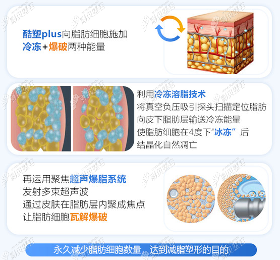 福州海峡整形医院酷塑溶脂的原理