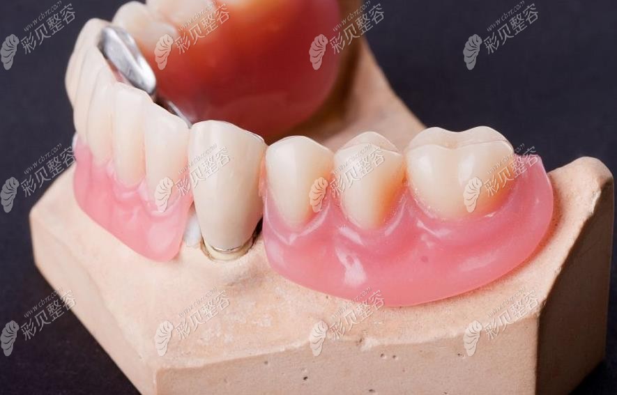 单颗缺失牙3种修复方式中活动假牙烤瓷牙种植牙哪个好