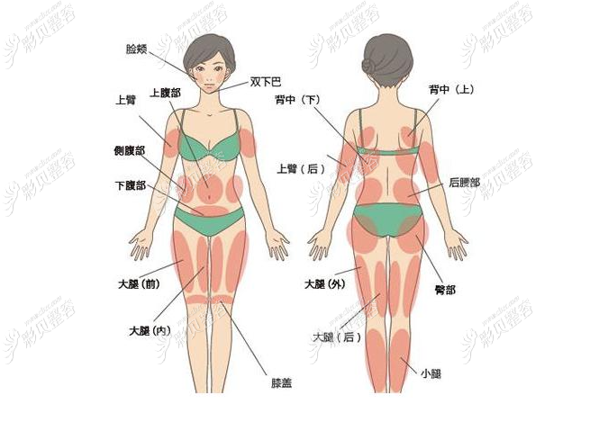 全身吸脂的部位包括上臂,下腹部,臀部,大腿等.