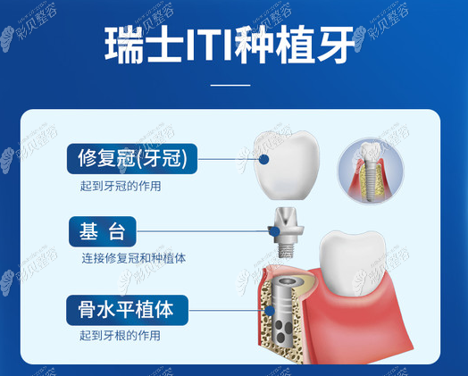 瑞士iti种植牙怎么样