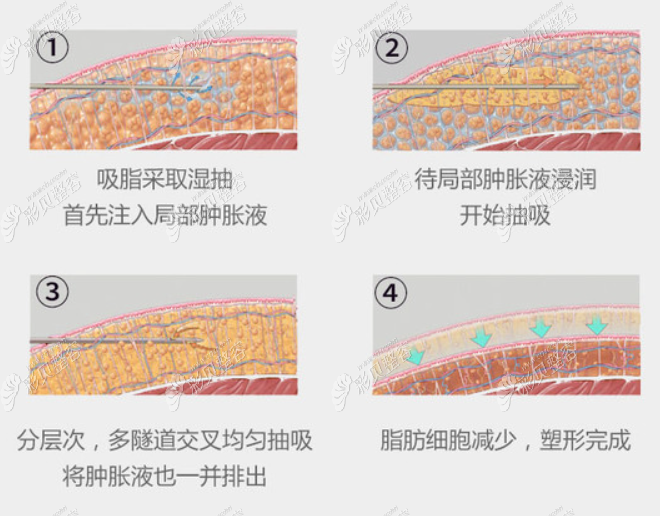 上海何斌医生的分层吸脂技术和口碑记录了他做抽脂好不好