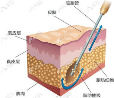 对比威塑吸脂和水动力吸脂的区别来分析做大腿吸脂哪个好