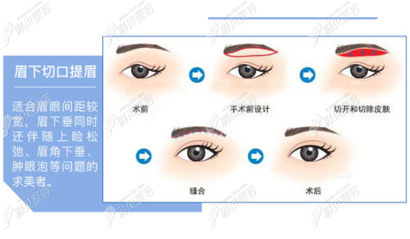 答案在这里:普通提眉手术和眉下悬吊的区别