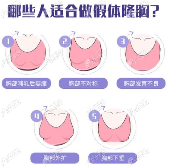 3,胸假体优势上的差别奥若拉假体:主要针对亚太女性胸型设计,相比曼托