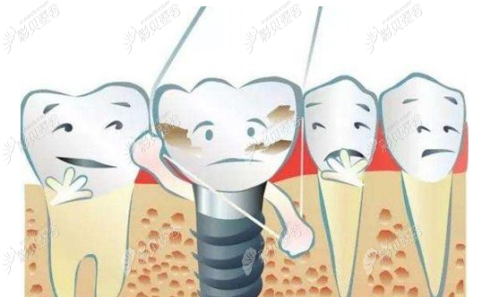 微创即刻种植牙容易得种植体周围炎吗和普通种牙有啥区别
