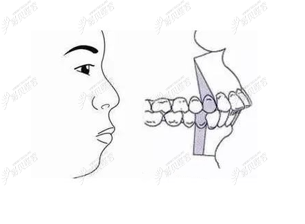 看下牙齿向内倾斜造成的原因来分析牙齿内扣有必要矫正吗