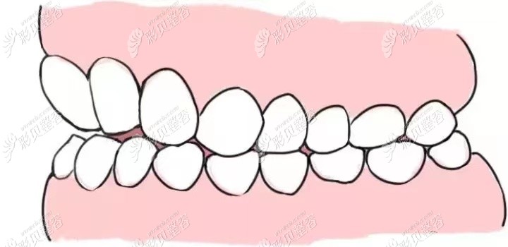 原因3:平时的咬合功能不良,无论是