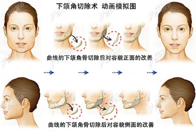 杭州磨骨医院排名里看做下颌角肥大矫正手术价格要多少钱