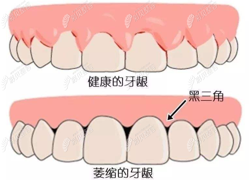 20岁以上的成人牙齿矫正后出现黑三角的原因和补救办法