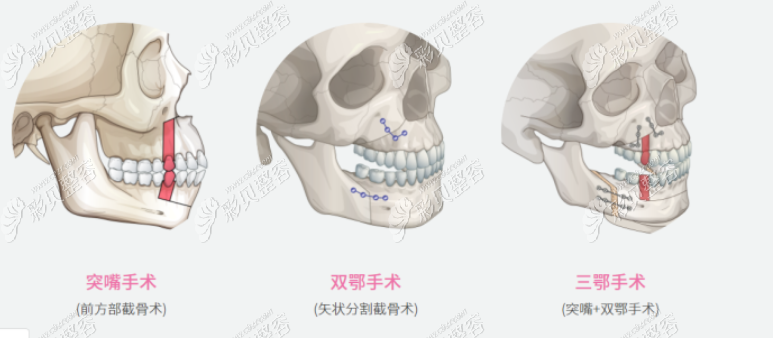 了解下巴截骨和双鄂手术区别后发现双颌矫正和磨骨不一样