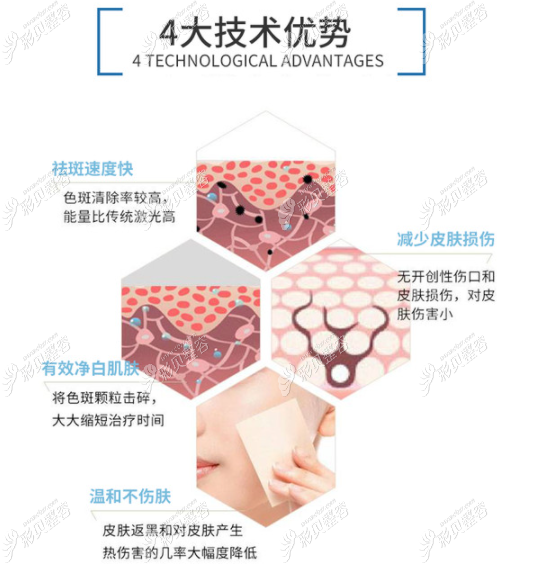 银川丽都用的调Q祛斑仪器的优势