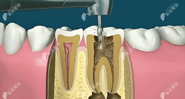 根管治疗详细步骤图解用8张图了解根管充填的目的是什么