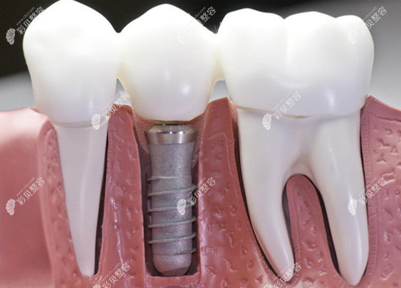 种植牙分几次才能做成功每次需要间隔多久