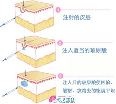 玻尿酸注射除皱步骤图