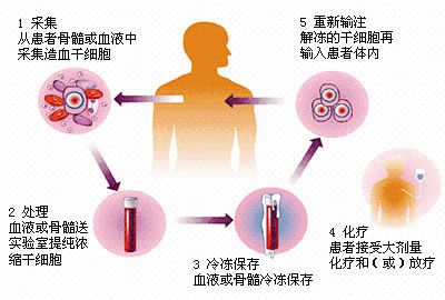 造血治疗过程