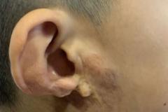 韩国普露菲耳整形郑在皓院长又一例耳畸形修复案例上线了