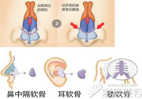 驼峰鼻示意图图片