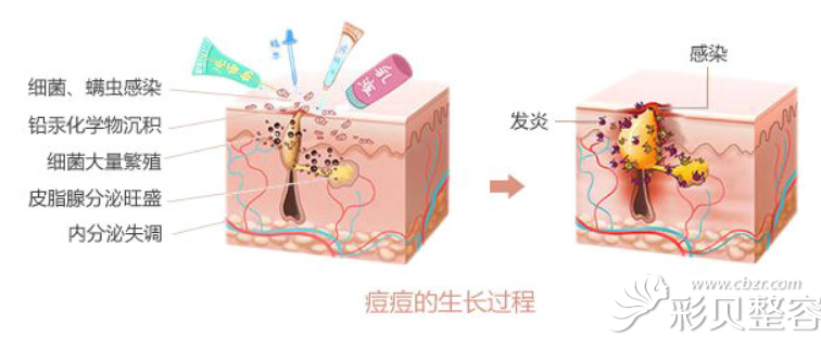 福州玛恩皮肤美容陈意蕾讲痤疮引起原因及是否可以喝牛奶