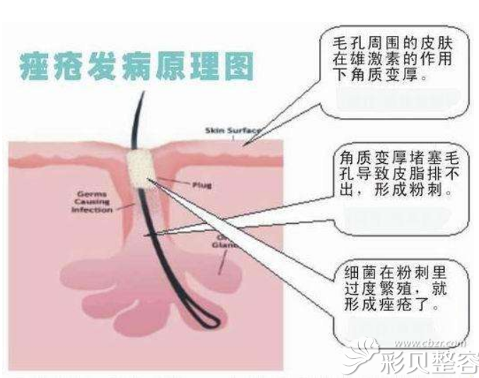 福州玛恩皮肤美容陈意蕾讲痤疮引起原因及是否可以喝牛奶