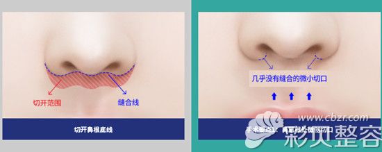 韩国做人中缩短手术优势