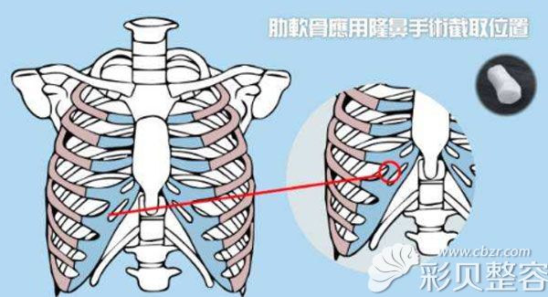 肋软骨隆鼻的取骨位置