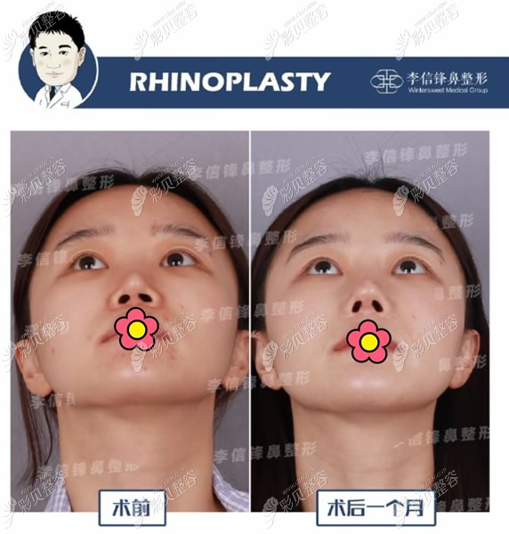 深圳李信锋医生做鼻子的案例图片好多有歪鼻修复鼻综合