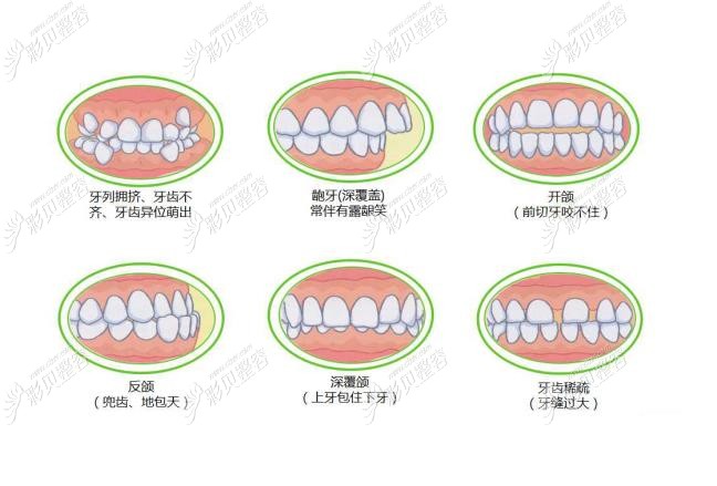 22岁在宜昌中汉口腔做牙齿咬合错位矫正后的对比图片及过程