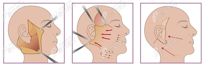 oz皮瓣面部手术图解图片