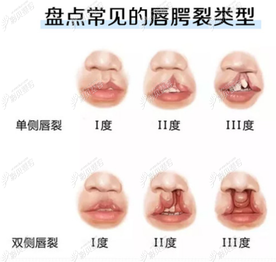 中国哪家医院做唇腭裂手术好被推荐的多附医保报销比例