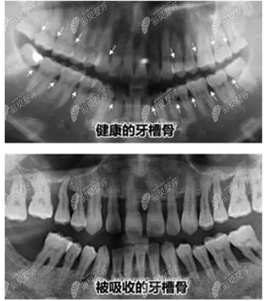 正常牙槽骨照片图片
