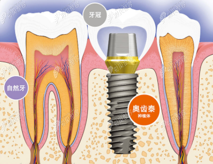 韩国奥齿泰种植体质量好不好