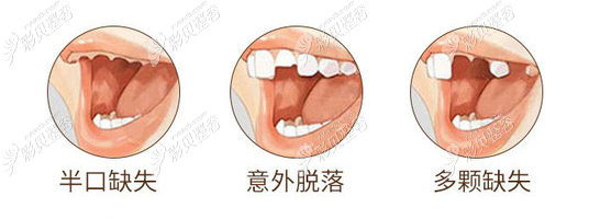 韩国登特斯种植体和奥齿泰价格要根据牙齿情况定价