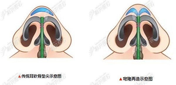 传统隆鼻与鼻尖穹隆对比