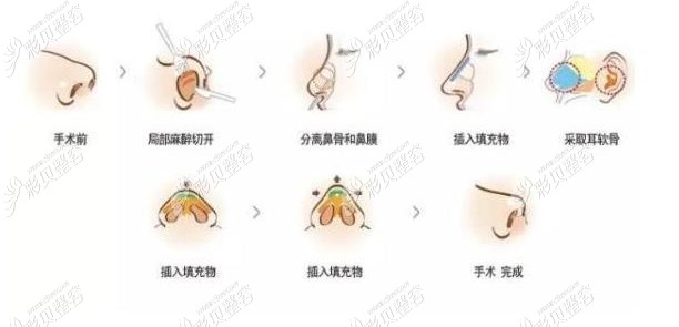 耳软骨隆鼻示意图