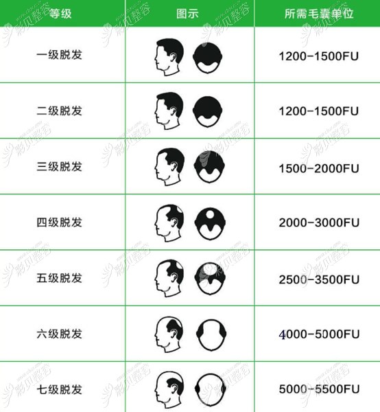 脱发17级程度图片及男女性不同脱发等级要种植的毛囊数量