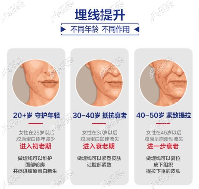 埋线提升不同年龄段改善作用不一样