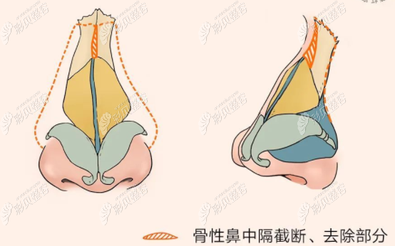 歪鼻矫正和鼻中隔偏曲矫正手术一样吗它们可以一起做吗