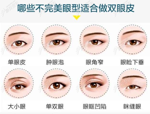 杭州做双眼皮修复比较好的医院给出了做眼综合的价格参考