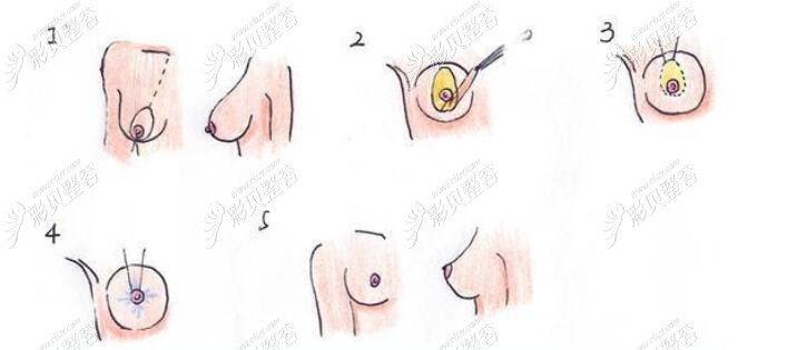 乳房悬吊术怎么做的图片