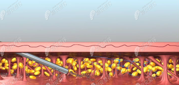面部吸脂原理图片
