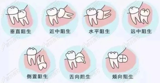 阻生牙的分类图片图片