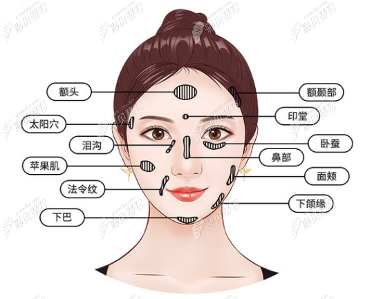 玻尿酸填充部位图图片